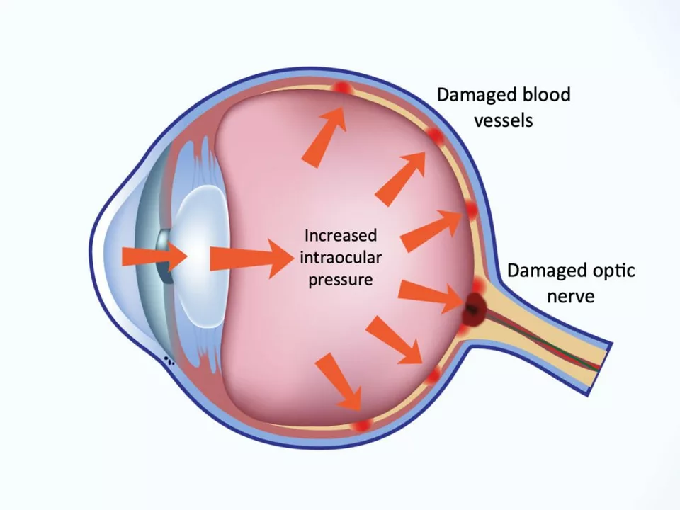 The Link Between High Eye Pressure and Glaucoma: What You Need to Know
